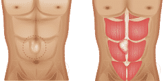 Abdominal hernia